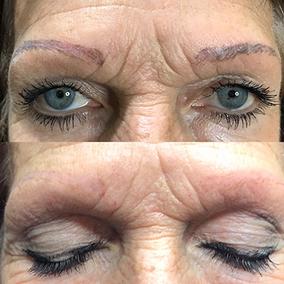 Before and after Rejuvi treatment